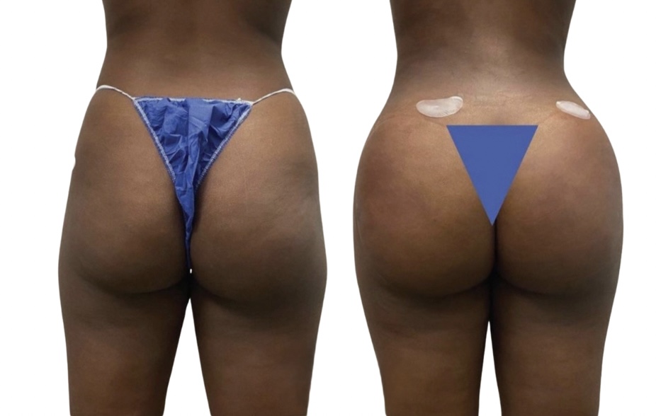Before: Brazilian Butt Lift (BBL)